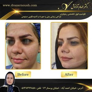 جراحی بینی گوشتی طبیعی