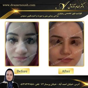 عمل بینی گوشتی فانتزی