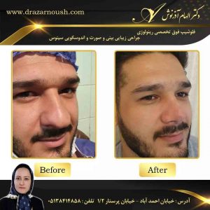 عمل بینی گوشتی مردانه طبیعی