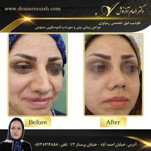 عکس عمل بینی گوشتی قبل و بعد