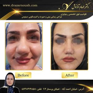 عکس قبل و بعد جراحی بینی گوشتی