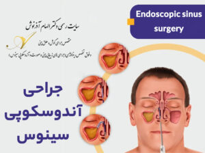 جراحی آندوسکوپی سینوس